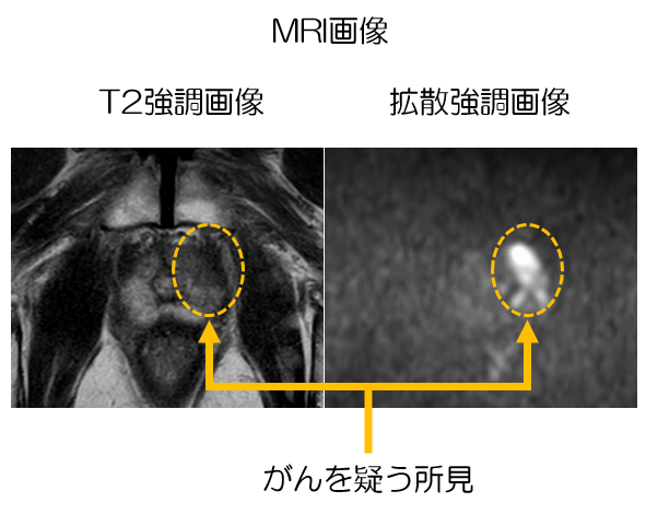 PSA検査とMRIの併用のイメージ